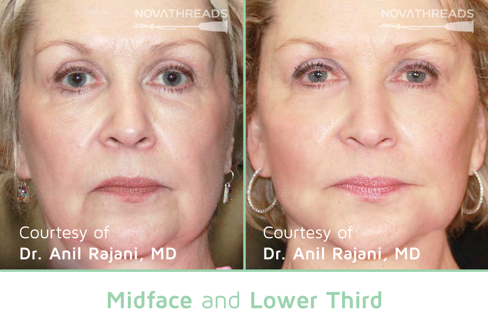 PDO Threads in Gainesville, FL Pure Aesthetics®